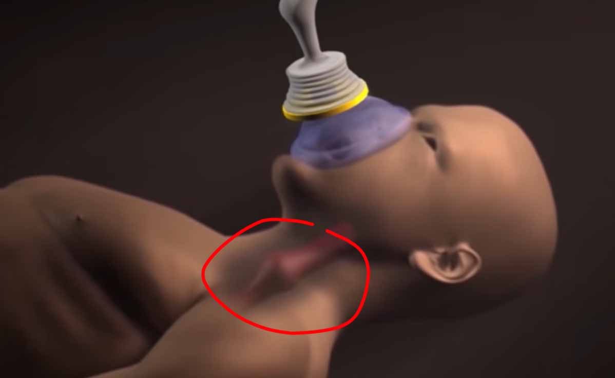 Animazione 3D: una maschera di aspirazione su bocca e naso di una figura infantile, con la zona del collo cerchiata di rosso.